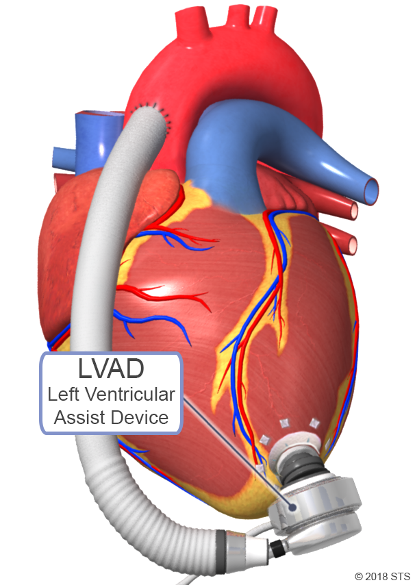 Wizualizacja LVAD Wizualizacja urządzenia wspomagającego serce (LVAD)